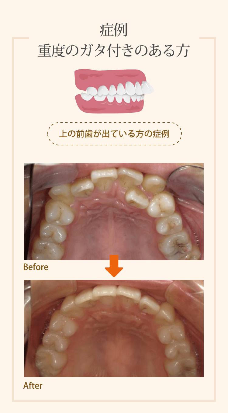 症例 重度のガタ付きのある方 上の前歯が出ている方の症例